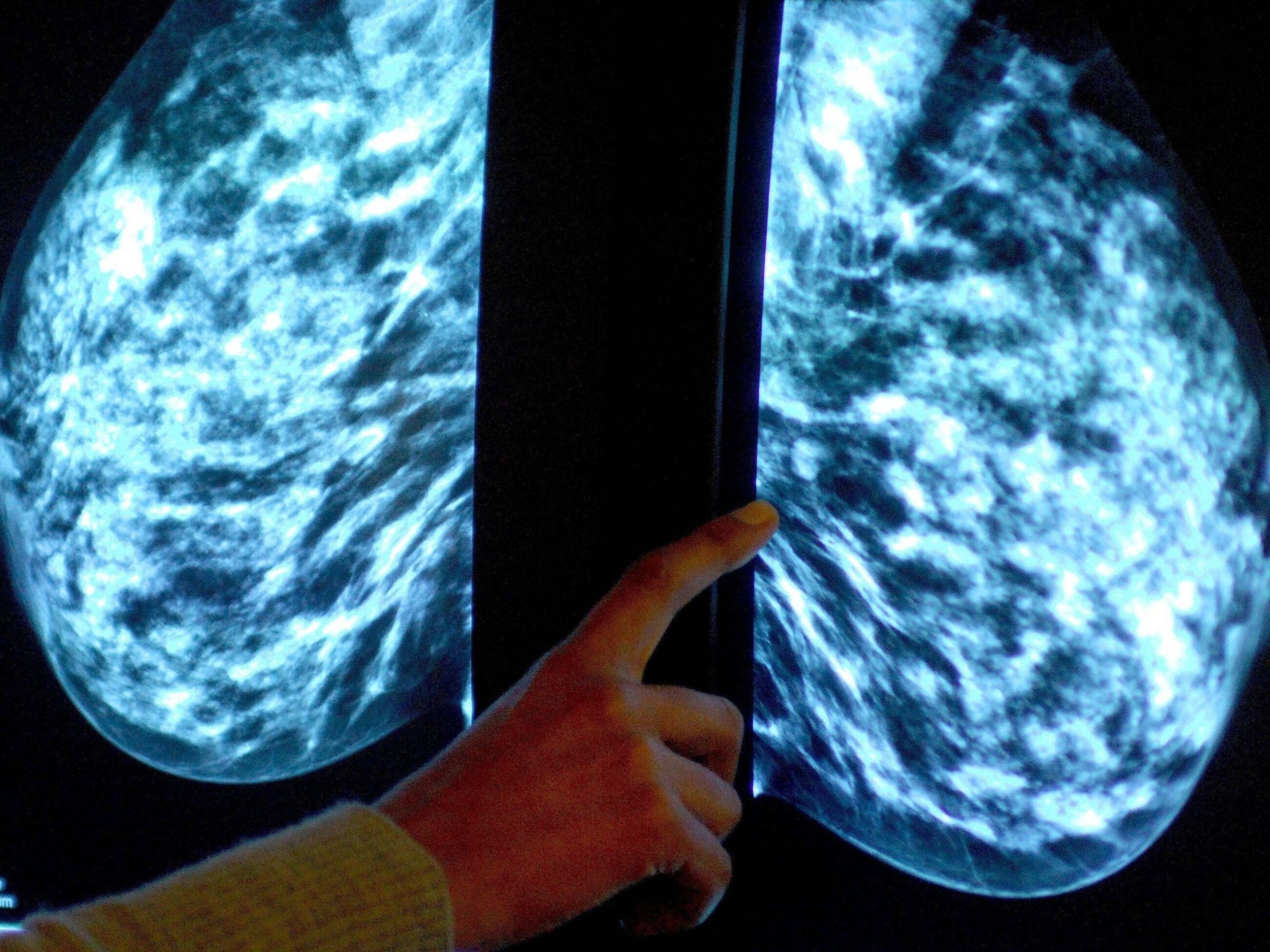 Artificial intelligence in medicine.  The Pole is working to detect breast cancer effectively and quickly