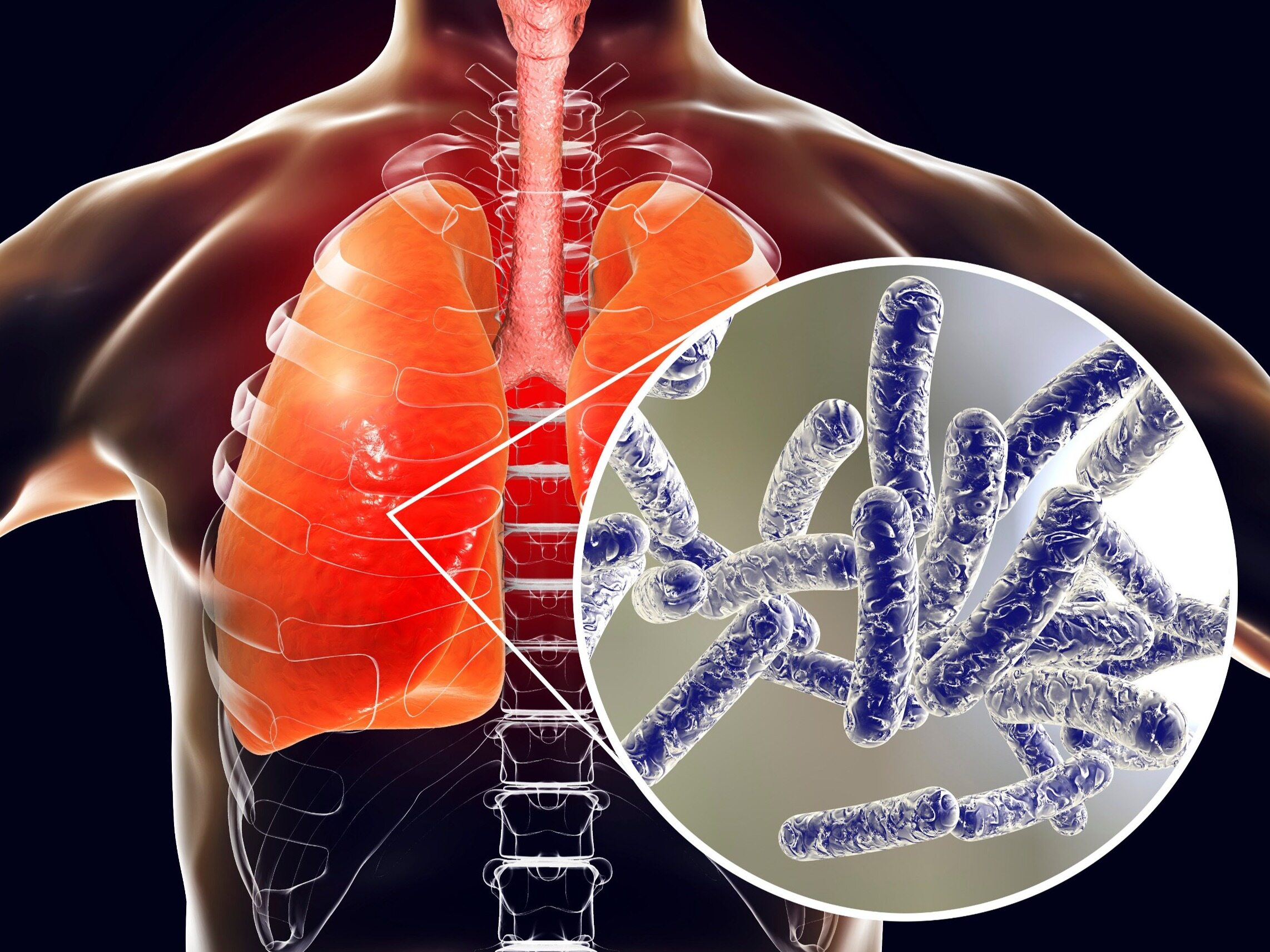 Legionnaires' disease - causes, route of infection, symptoms and treatment