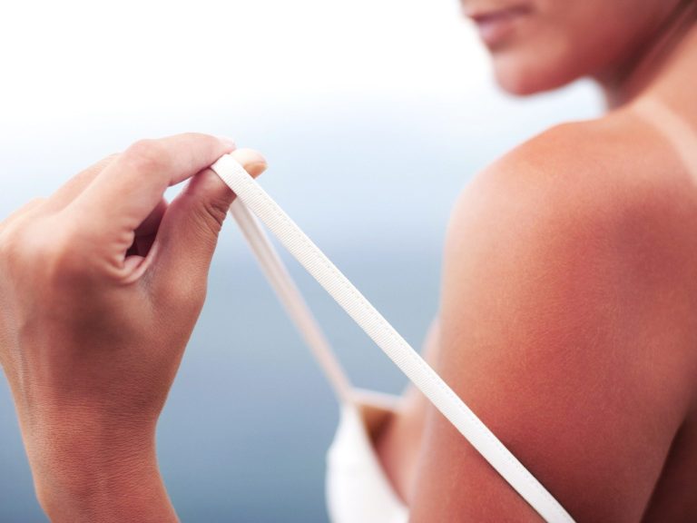 How to relieve sunburn?  A dermatologist reveals a little-known trick