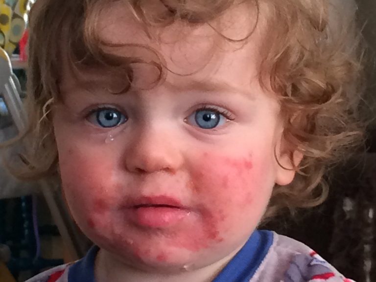 A mysterious rash kept children at home before Christmas.  Is erythema infectiosum dangerous?